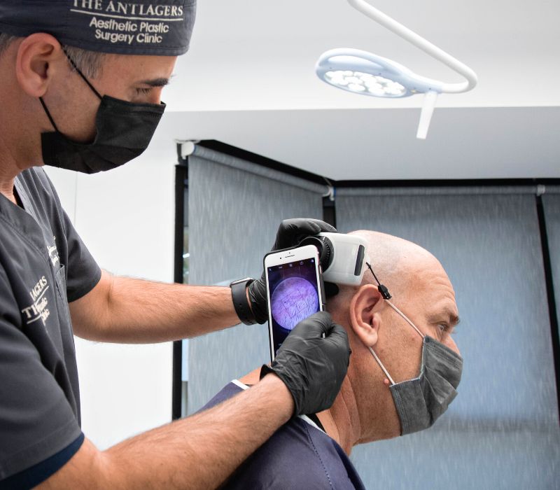 Ο γιατρός δείχνει τον σχεδιασμό της μεταμόσχευσης μαλλιών στον ασθενή