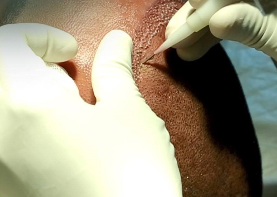 implant